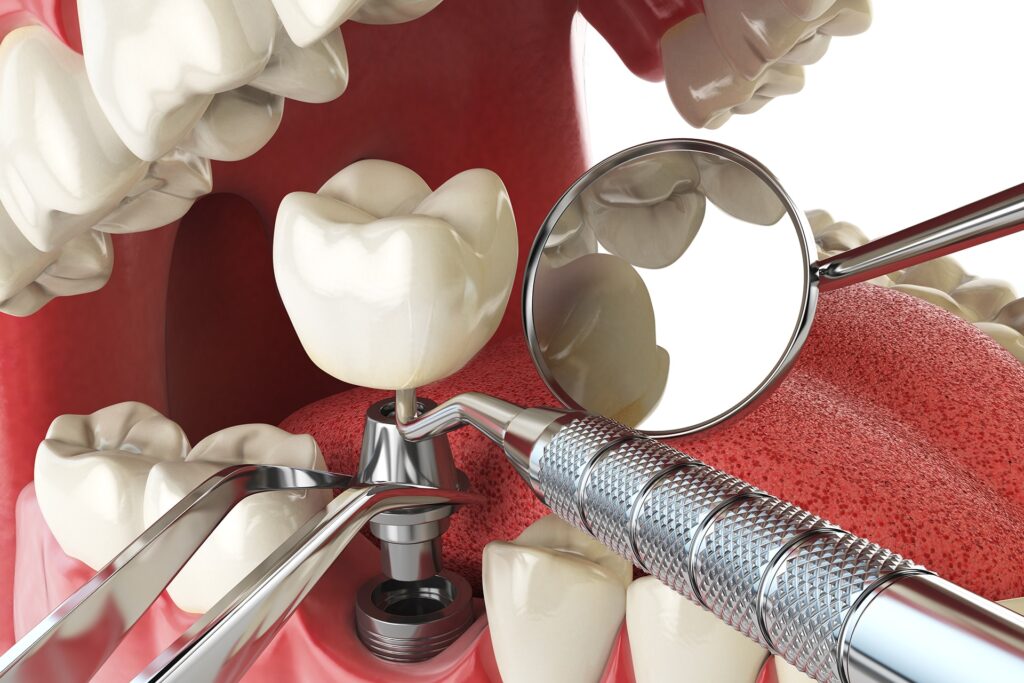 Implantes Carga Inmediata Hero