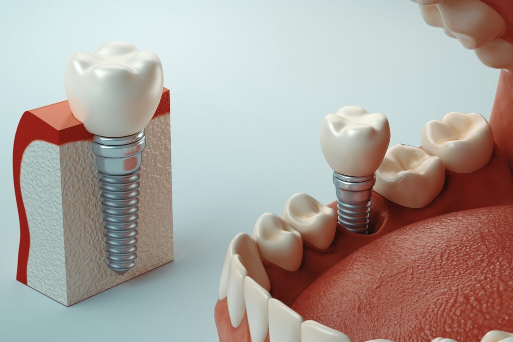 Implantes Dentales Hero