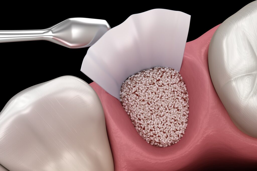 Injertos Oseos Hero