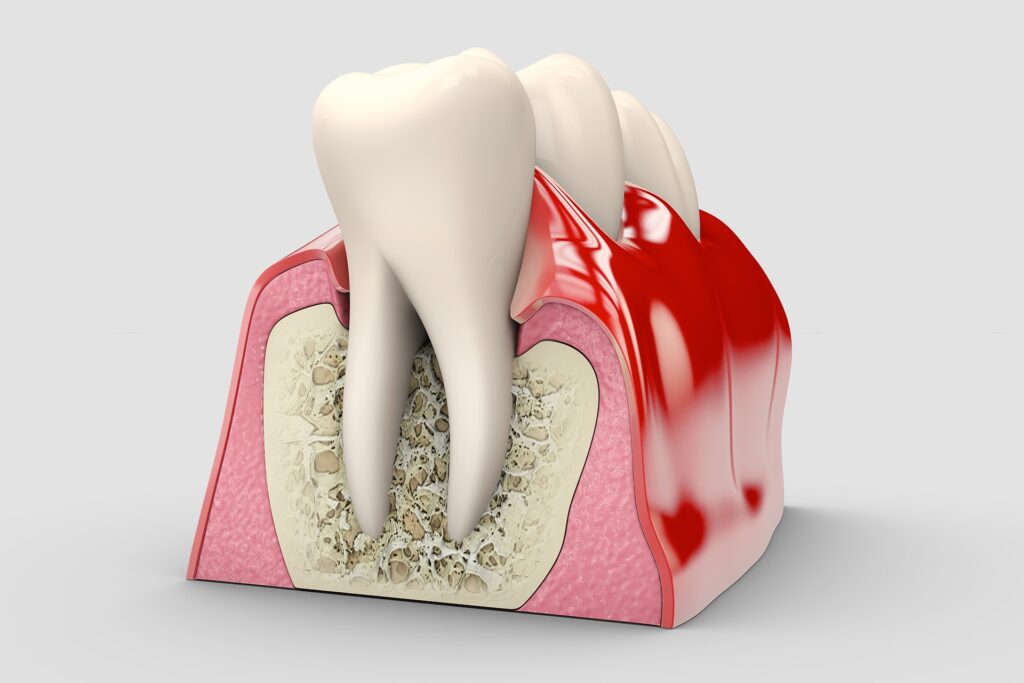 Periodoncia Hero
